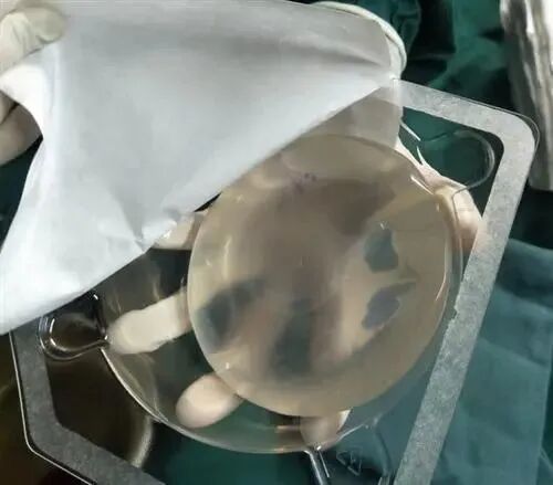 隆胸假体取出能恢复原状吗？有什么副作用？