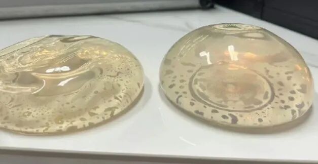 曼托假体丰胸效果好不好?真实反馈来了插图1 图片
