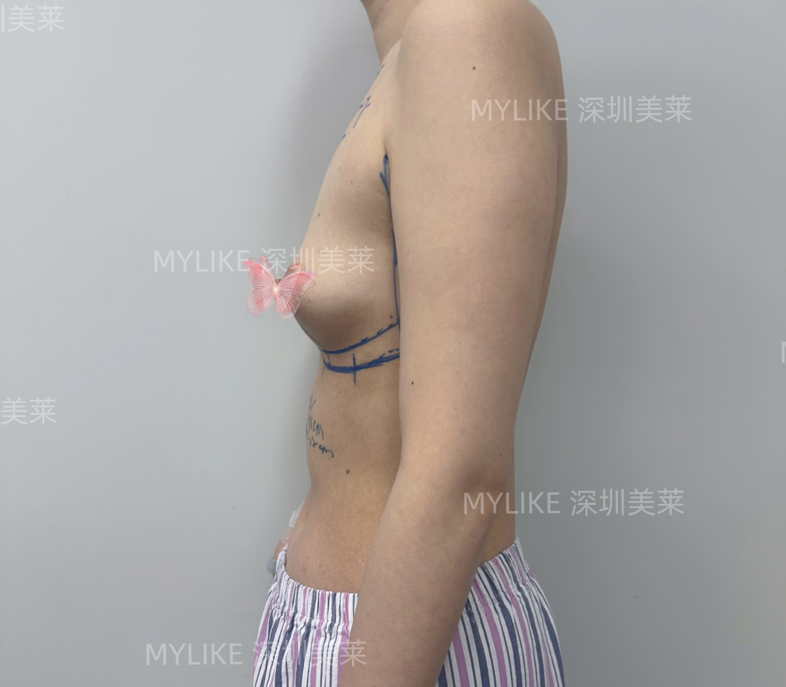 术前