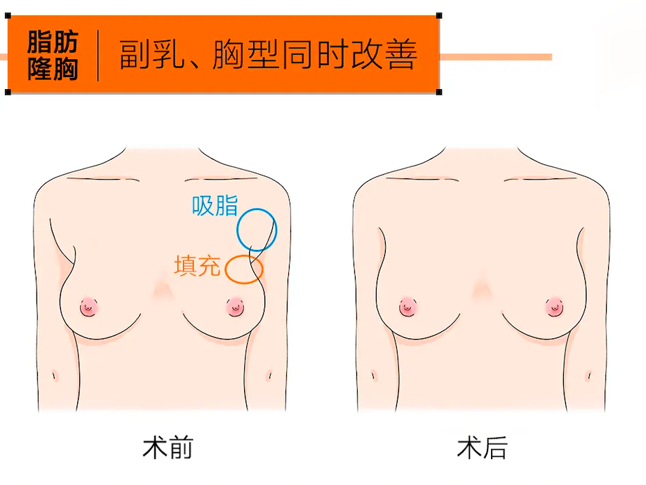 自体脂肪丰胸会有结节吗？自体脂肪隆胸结节怎么办？