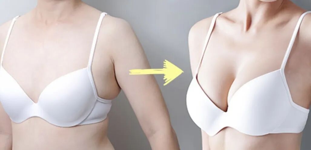 假体隆胸对身体健康有影响吗？假体隆胸可以用力抓吗？