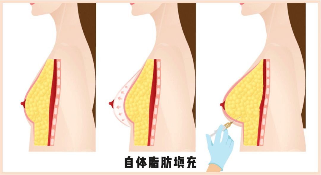 脂肪隆胸300ml有多大？自体脂肪隆胸后会变小吗？