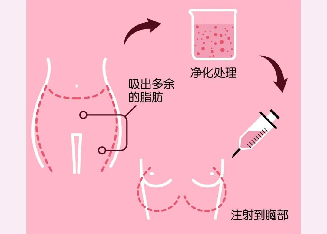用自己的脂肪隆胸安全吗？自体脂肪隆胸多久恢复正常？插图