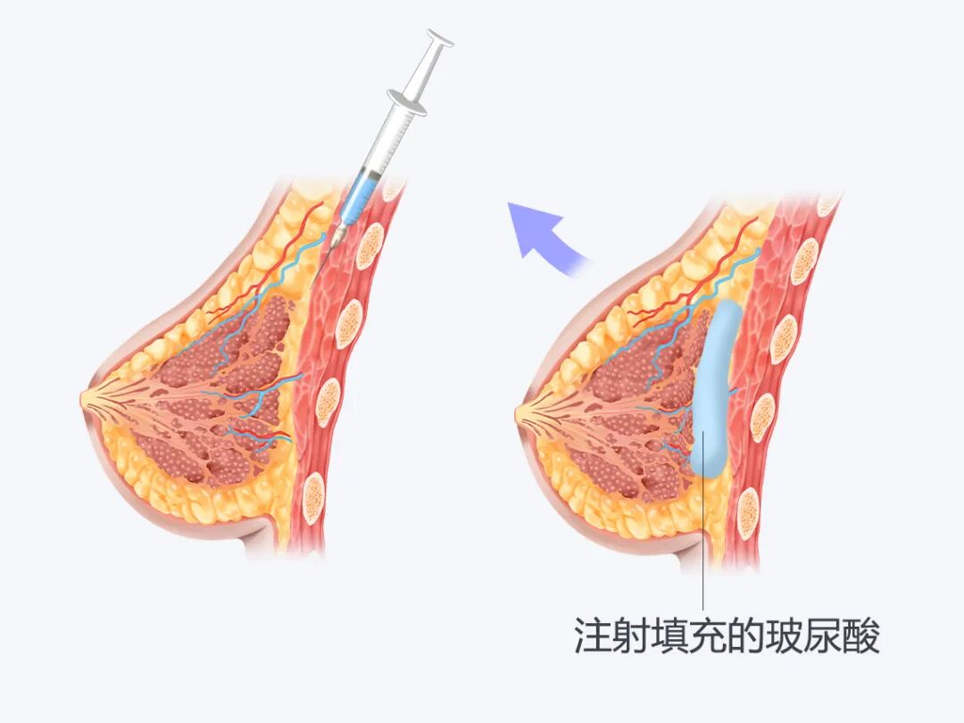 注射丰胸安全吗?会留下后遗症吗?