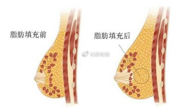 上海自体脂肪移植隆胸价格一般多少钱？手术费用及注意事项