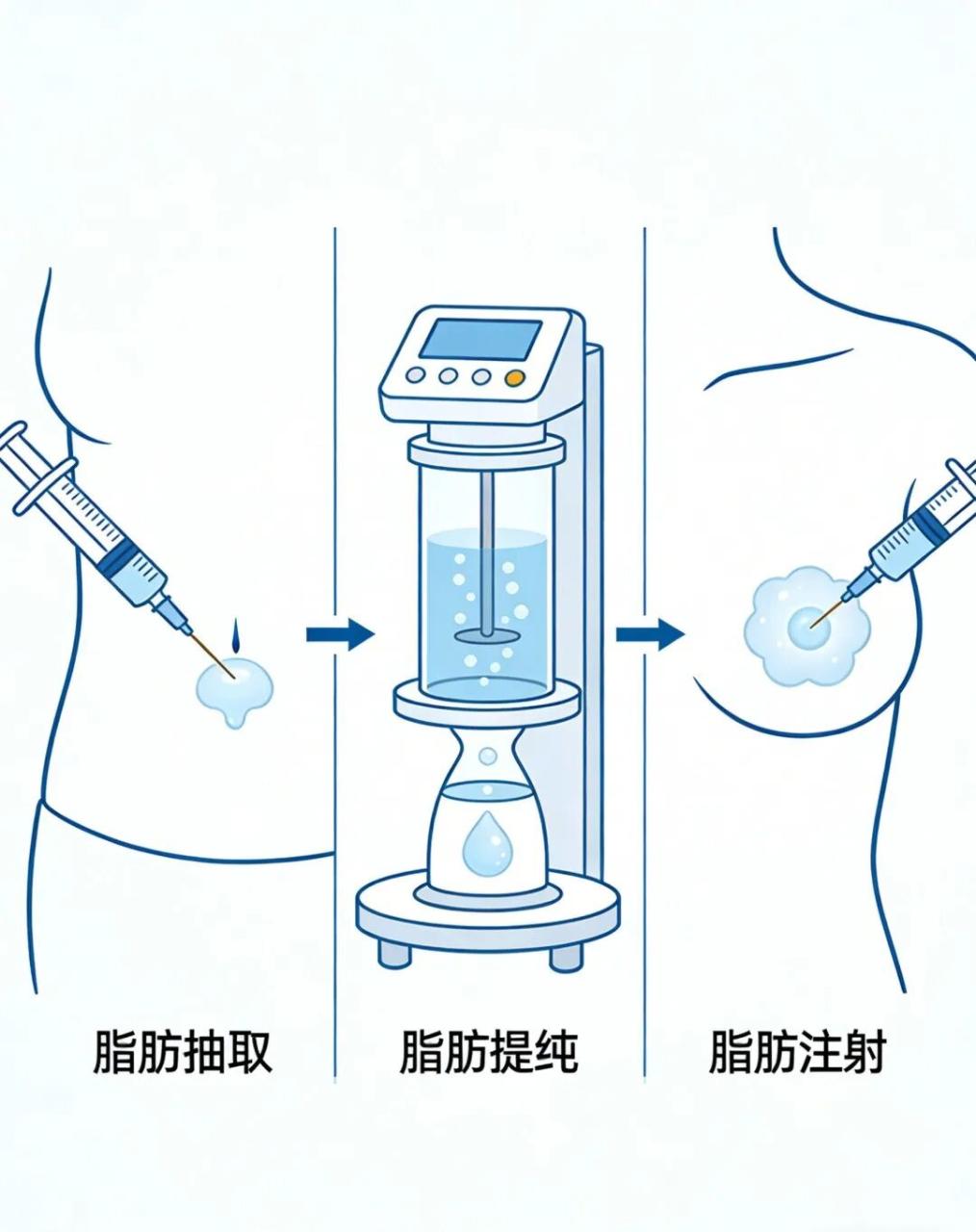 自体脂肪隆胸安全吗？隆胸手术后穿多少天固定内衣？