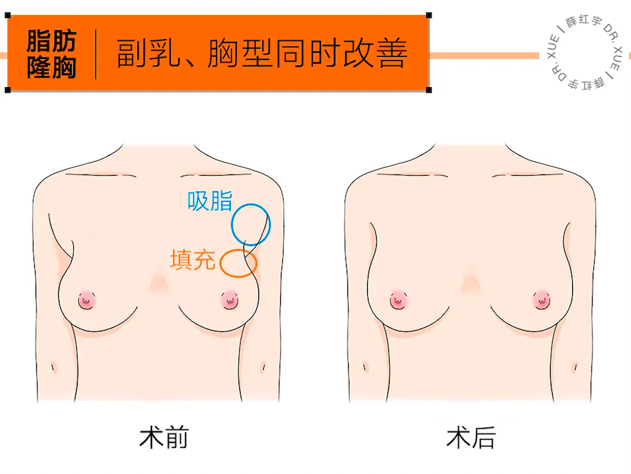 脂肪隆胸有后遗症吗？脂肪隆胸恢复期要多久？