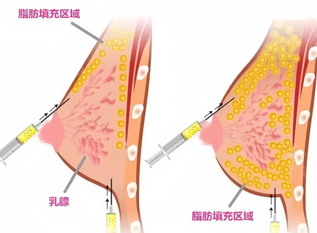 自体脂肪隆胸一般要做几次？自体脂肪隆胸要花多少钱？
