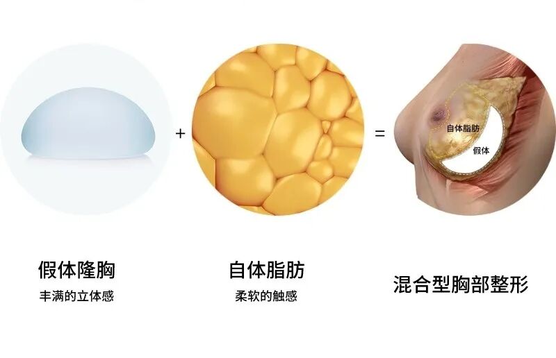 假体隆胸很疼吗？假体隆胸如何预防包膜挛缩？