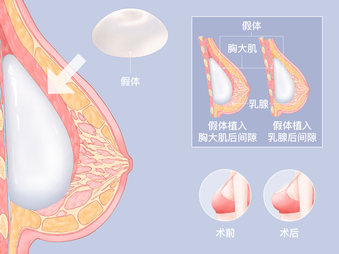 假体隆胸消肿后会变小吗？假体隆胸一个月定型了吗？