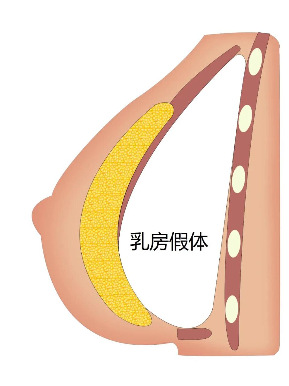 假体隆胸取出后会怎样？假体取出后胸会变形吗？