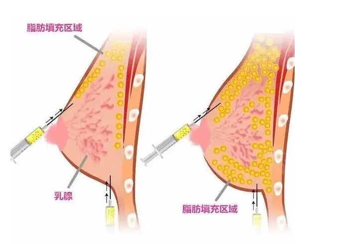 太瘦了可以自体脂肪隆胸吗？自体脂肪隆胸多少钱？