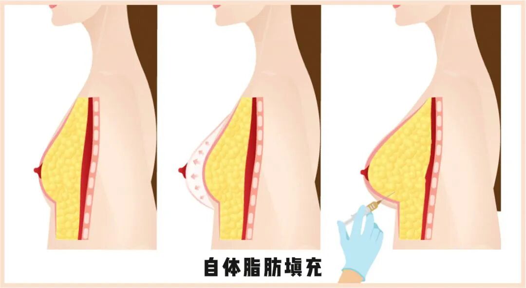 自体脂肪隆胸怎么护理？自体脂肪隆胸风险及预防？