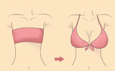 脂肪丰胸多久完全变软？隆胸后能哺乳吗？