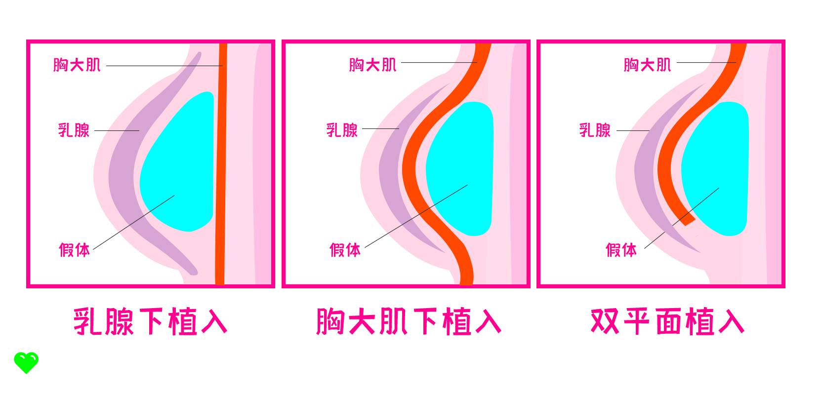 假体隆胸可以放多久？术后怎么护理？