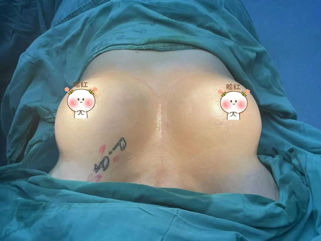 假体隆胸和脂肪隆胸哪个好？隆胸后可以用力抓吗？